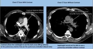 Comparing Efficacy Of CT Methods For Lung Cancer Surveillance