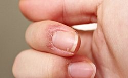 Neden tırnak kenarı etlerini kopardıktan sonra hemen yere yüngülce dokunsak bile orada sızıntılı ağrı hiss ediyoruz?