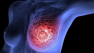 Mutlak Risk ve Göreli Risk Nedir? Yüzdelik Değişimler Ne Anlama Geliyor?