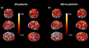 Comparison Of Beta-Amyloid Tracers Indicates Cognitive Impact