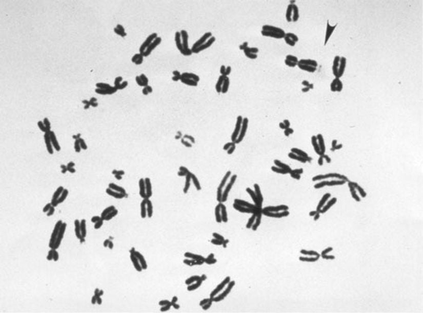 Görsel 3. Belirteç X kromozomu. Kırılgan X bireylerde karakteristik olarak gözlenen X kromozomunun uzun kolunun ucundaki tuhaf daralmayı gösteren metafaz kromozomları. Sağ üst köşedeki siyah ok ucu, belirteç X kromozomunu göstermektedir. Görsel Kaynağı: Penagarikano, O., Mulle, J., & Warren, S. T. The pathophysiology of fragile X syndrome. Annual Review of Genomics and Human Genetics 8, 109–129 (2007).