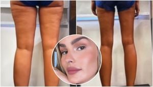 Yasmin Brunet Opens Up About Lipedema Journey