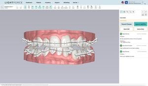 3D Printing Angles Transform Orthodontic Bracket Accuracy