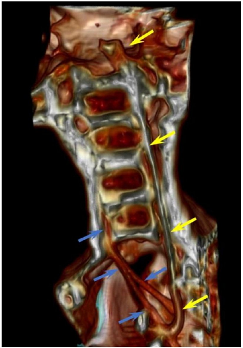 Şekil 17. Dört boyun omurunu gösteren boynun sagital kesiti. Sarı oklar  arka kordonu, mavi oklar ise öndeki iki kordonu göstermektedir.