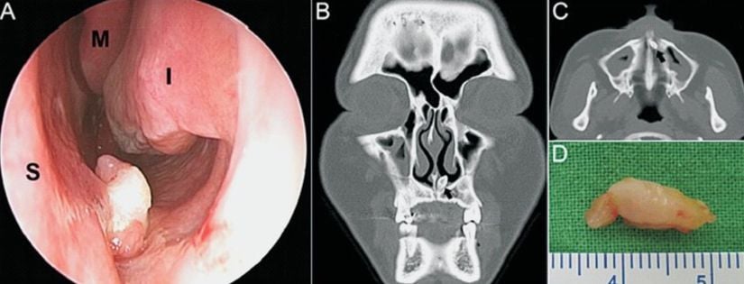 Burunda diş: nazal kavitede ektopik diş örneği