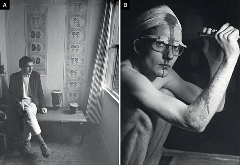 Hugo Bart Huges ve kendine trepanasyon uygulaması