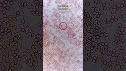 Bir Tüberküloz mikrobunun akyuvar hücreleri tarafından saf dışı bırakılması.