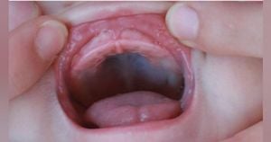 Study Reveals Prevalence Of Newborn Oral Anomalies In Ha'il Region