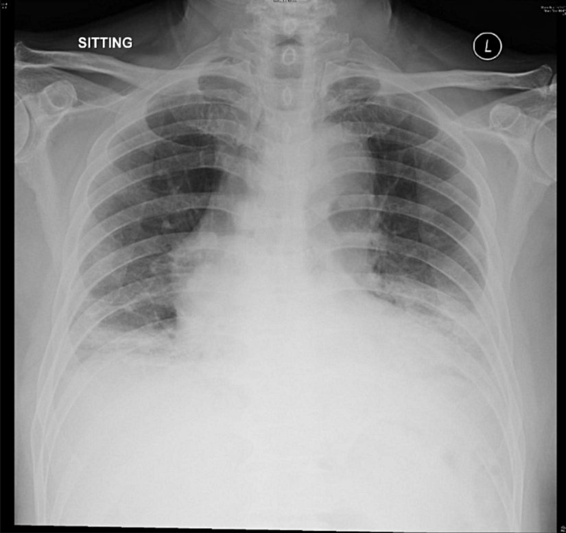 OC43 Hastasının Akciğer Görüntüsü