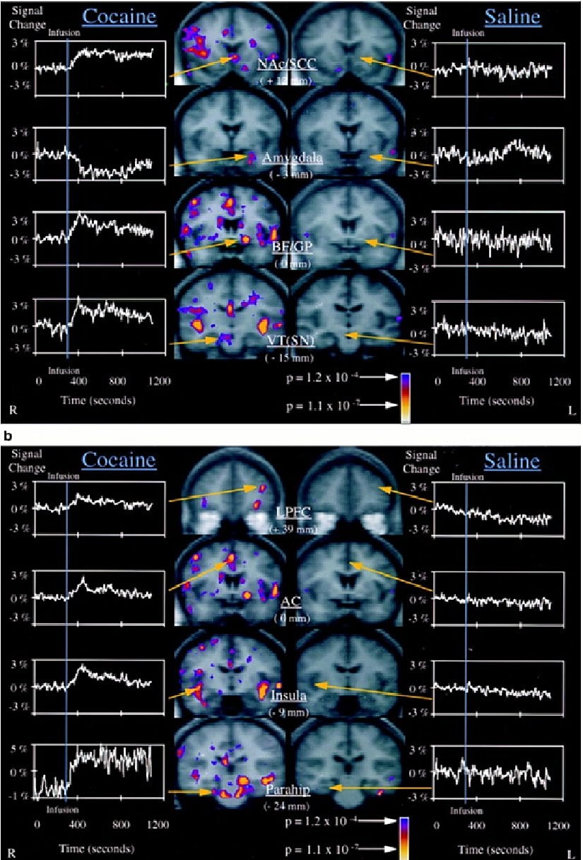Şekil 1. Kokain ve Salin ile Bölgesel Beyin Aktivasyonu   (a) Kokainden sonra önemli fMRI sinyal değişiklikleri gösteren, ancak salininfüzyonlarından sonra olmayan subkortikal beyin bölgelerinin görüntüleri. Solda, kokain alan on denekten ortalama fMRI verileri için infüzyon öncesi ve sonrası zaman noktalarının dört koronal seviyesindeki Kolmogorov-Smirnov (KS) istatistiksel haritaları bulunmaktadır. Bu KS istatistiksel haritaları, karşılık gelen gri tonlamalı ortalama yapısal haritalar üzerinde sözde renkte kaplanmıştır. Pozitif sinyal değişikliği olan aktivasyonlar NAc/SCC, BF/GP ve VT'yi içerirken, negatif sinyal değişikliği olan aktivasyonlar amigdalayı içerir.   (b) Kokain ve salininfüzyonlarından sonra diğer paralimbik ve heteromodal korteks aktivasyonlarının görüntüleri. Gösterilen bölgeler arasında lateralprefrontal korteks (LPFC), anteriorsingulat, insula ve parahipokampalgirus bulunur. Görüntü ve grafik düzeni (a)'da açıklanan kuralları takip eder.