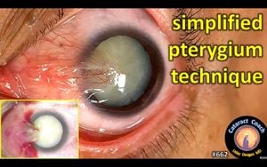 Identifying Risk Factors For Pterygium Recurrence After Surgery