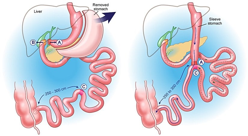Duodenal switch, diğer bariatrik prosedürlerle karşılaştırıldığında, süper morbid obezitesi olan hastaların kilo verme hedeflerine ulaşmalarına yardımcı olma şansı daha yüksektir. Ayrıca, özellikle uzun süre insülin tedavisine ihtiyaç duyan hastalarda, diyabet için diğer prosedürlerden daha etkilidir. Bununla birlikte, bu etkinliğin daha yüksek beslenme eksikliği riski ile dengelenmesi gerekir.