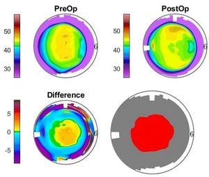 New Study Compares Symmetric And Asymmetric Offset Techniques In PRK