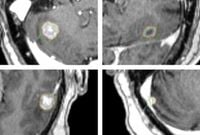 MRI distortion correction is associated with improved local control in stereotactic radiotherapy for brain metastases - Scientific Reports