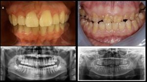 Japanese Nationwide Survey Reveals Novel Oral Manifestations Of Hypophosphatasia