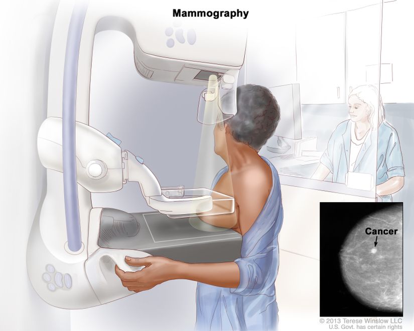 Mamografi