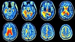 Pozitron Emisyon Tomografisi (PET) Nedir? PET Taraması ile Görüntüleme Nasıl Yapılıyor? Hastalar Nasıl Bir Süreçten Geçiyor?