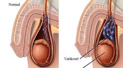 Varikosel erkekler nasıl bir yaşam stiline sahip olmalı?