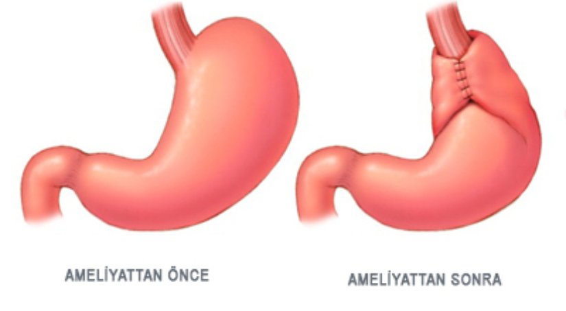 Çizimde gördüğünüz gibi mantık gayet basit aslında ama bu sadece görünüşte böyle. Midenin şişkin, bombe üst kısmı, yemek borusunun en alt kısmı üzerine yaka biçiminde sarılırak dikilir (fundoplikasyon). Bu şekilde yeniden bir yüksek basınçlı bir boğum (sfinkter=geçit) mekanizması oluşturulmuş olur..
