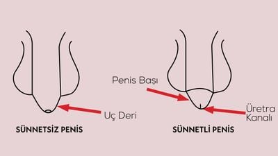 Sünnetin Faydaları ve Zararları: Sünnet, Sağlıklı Bir Uygulama mı? Penis Ön Derisi Neden Var ve Nasıl Evrimleşti?