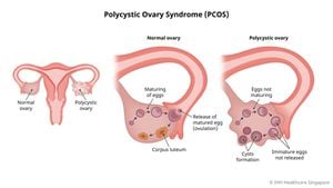 Study Links Follicular Distribution Patterns To Ovarian Disorders