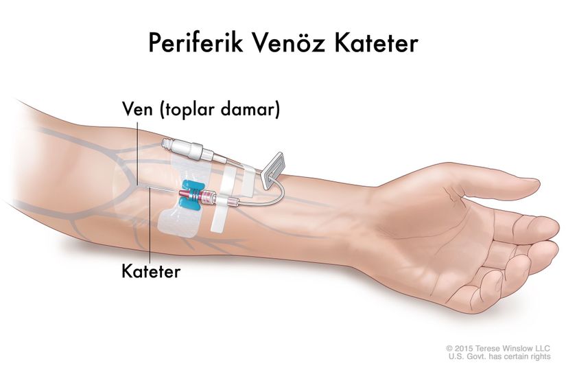 Enkaz altında kalanların kolları veya bacakları görülebiliyorsa, çıkarma işlemi uzun sürecekse, sonrasında “kurtuluş ölümü” gerçekleşmemesi adına olay yerinde izotonik sıvı (yetişkin 1000 ml/sa, iki saatten sonra 500 ml/sa; çocuk 15-20 ml/kg/sa) başlanması hayati önem taşımaktadır.