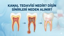 Dişin Sinirleri Neden Alınır?