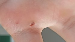 Elimdeki küçük yaranın kabuğunu soydum ve paslı bölgelerle kısmi temasta bulundum. Tetanos aşısı ne zaman olmalıyım?