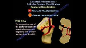 Calcaneocuboid Joint Impact On Sustentacular Fragment Displacement Revealed