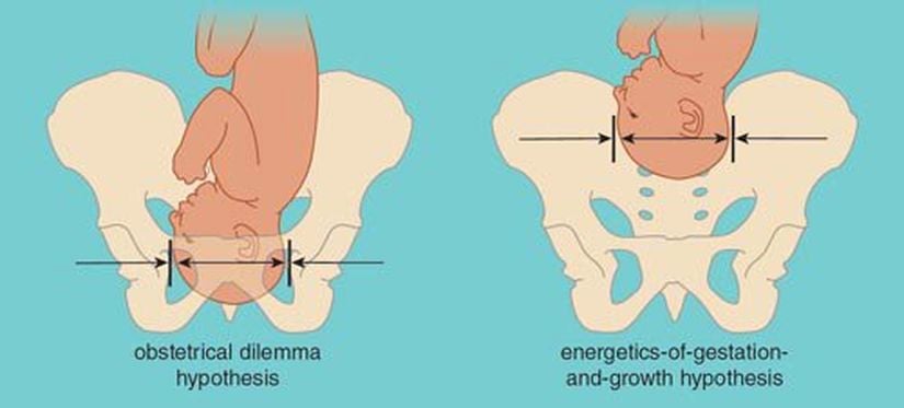 Obstetrik Çelişki Hipotezi'ni anlatan bir diğer görsel...