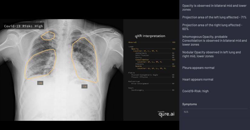 Qure.ai'nin qXR sistemi. Akciğer grafisindeki akciğer bulguları işaretlenmiş ve covid risk değerlendirmesinin ardındaki mantık açıklanmıştır.