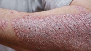 AI Neural Network Generates Realistic Images Of Psoriasis