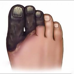 İleri derece Kangren olan uzuvlarımız neden siyah olur?