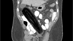 Intraperitoneal Kabak Tomografisi: Vücudunuza Yabancı Cisimler Sokmayın!