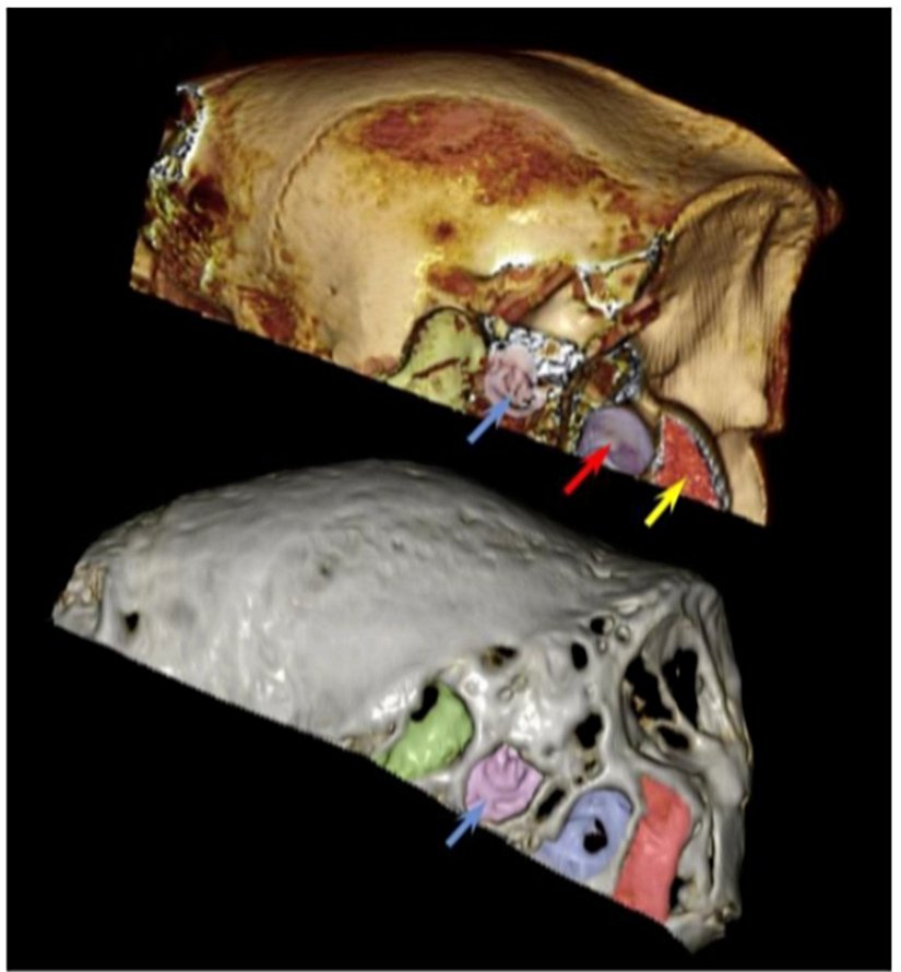 Şekil 14. Lama (üstte) ve Josephina'da (altta) kulak boşluğunun ön ve  arka kısmındaki boşlukların karşılaştırılması büyük benzerliğe işaret  etmektedir. Kulak boşlukları mavi oklarla gösterilmiştir. Kırmızı ok şunu  gösterir:  ventral condyloid fossa ve sarı ok lamadaki oksipital kondildir.
