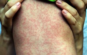 Measles Outbreak Alarm: Tokyo Man Exposes Many During Trip