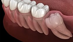 Yirmilik Dişlerimiz Neden Varlar?