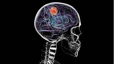 Beyin Kanseri, Kafatasının Bazı Kısımlarını Eritebilir!