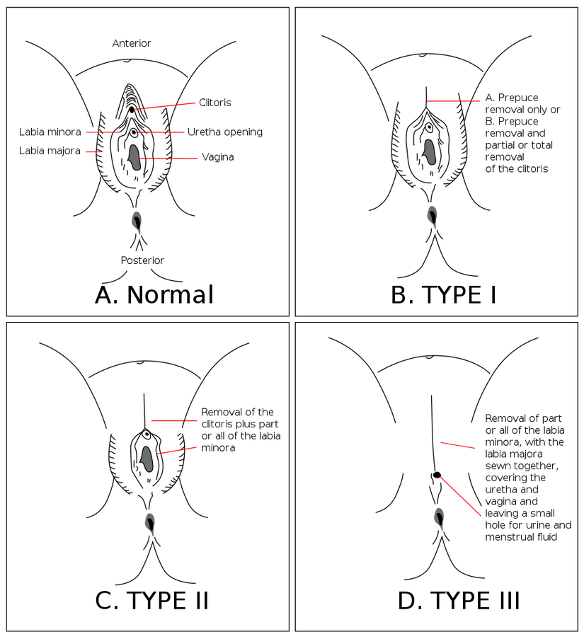 Kadın genital mutilasyonunun farklı tipleri.