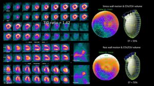 Study Links Health Factors To Myocardial Perfusion Changes