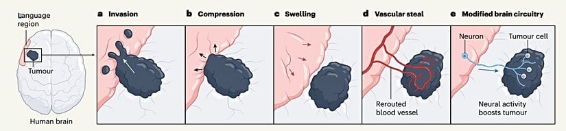 Tümörün beyin dokusunu sıkıştırması ve dokudan kan çalması. (Tümör dokusu siyahla, beyin dokusu pembe ile gösterilmiştir.)