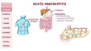 Rheumatoid Arthritis Linked To Increased Pancreatitis Risk