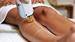 Lazer epilasyonun mantığı nedir? Nasıl çalışır?