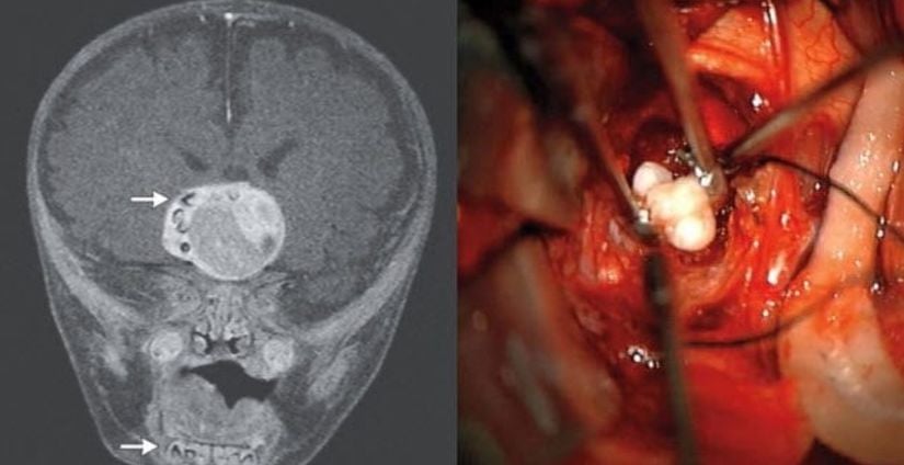 4 aylık bebekte beyin tümörü: Beyin tümörü şüphesi ile çekilen T1 Ağırlıklı MRI ve tümörün çıkartılma anı