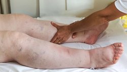 Bacakta Lenfödem Belirtileri ve Nedenleri