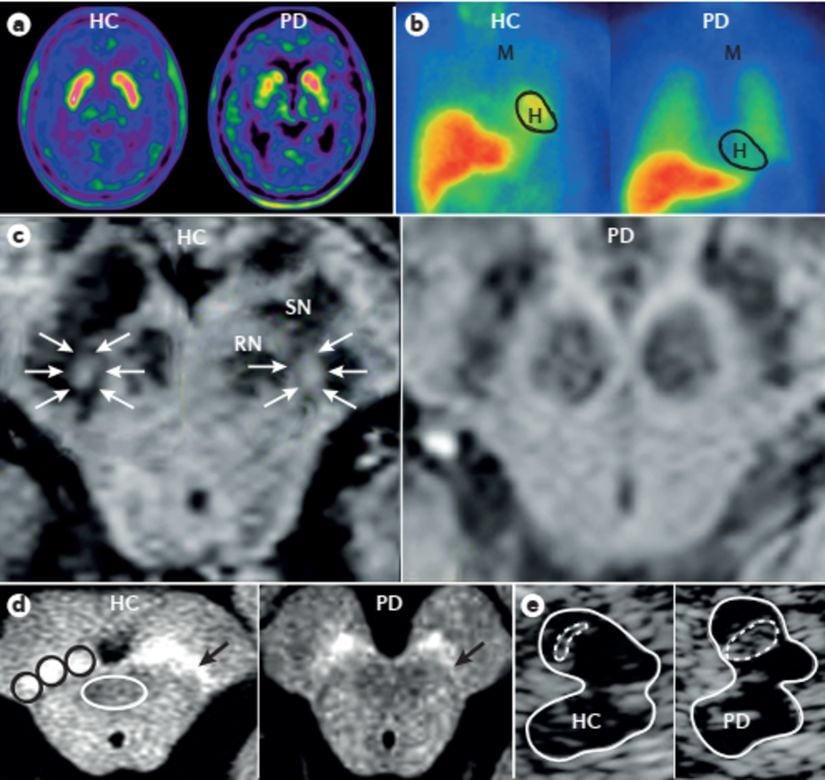 Parkinson hastalığını incelemek için kullanılan görüntüleme yöntemleri. a | 18F-DOPA-PET görüntüleri, sağlıklı bir kontrolde (HC; sol panel) putamen ve kaudat çekirdeklerde (tipik virgül şeklinde bir yapı) normal bilateral izleyici alımını gösterirken, alım asimetriktir ve sağda daha belirgin azalma ile erken evre ağırlıklı olarak sol taraflı Parkinson hastalığı olan bir hastada sol putamen (PD; sağ panel). b | Metaiodobenzilguanidin tek foton emisyon CT'si (MIBG SPECT), bir HC'ye (sol panel) kıyasla erken PD'li bir hastanın (sağ panel) kalbindeki (H) MIBG alımında büyük bir azalma ile kardiyak sempatik denervasyon gösterir. c | Substantia nigra'nın (SN) MR görüntülemesi. Sol panel, PD'li hastalarda bulunmayan dorsolateral SN içinde ovoid bir hiperintensite (oklar) gösteren bir HC'nin duyarlılık ağırlıklı görüntüleme (SWI) taramasını gösterir (sağ panel). d | SN'nin nöromelanine duyarlı MRI'si (sol paneldeki siyah daireler), HC'ye (sol panel) kıyasla erken PD'li bir hastada (sağ panel) lateral kısımda (ok) azalmış sinyal yoğunluğu gösterir. Periakuaduktal gri cevherde (sol panelde beyaz daire) hiçbir değişiklik gözlenmedi. e | Transkraniyal ultrasonografi (eksenel düzlem), bir HC'ye (sol panel) kıyasla PD'li bir hastada (sağ panel) SN bölgesinde genişlemiş bir ekojenite alanı gösterir. Düz çizgiler orta beyin alanını, noktalı çizgiler insonasyonun yanındaki SN'nin anatomik bölgesindeki ekojenik alanı işaretler. M, mediasten; RN, kırmızı çekirdek.