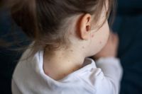 Millions of children to receive chickenpox vaccine on NHS