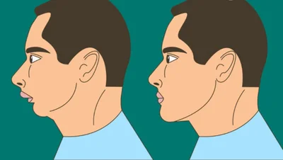 Mewing Nedir? Ameliyat Olmadan Estetik Bir Yüz Şekli Kazanmak Mümkün mü?
