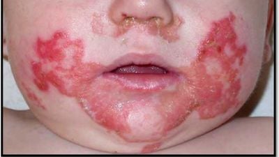 Akrodermatitis Enteropatika Nedir? Kalıtsal Çinko Eksikliği Deriyi Neden Bozar ve Nasıl Tedavi Edilir?