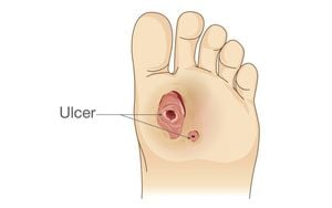 High Rates Of Diabetic Foot Ulcers Found Among Workers